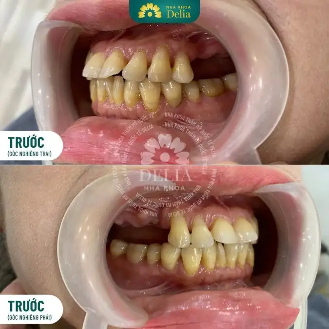 nằm mơ gãy răng hàm dưới