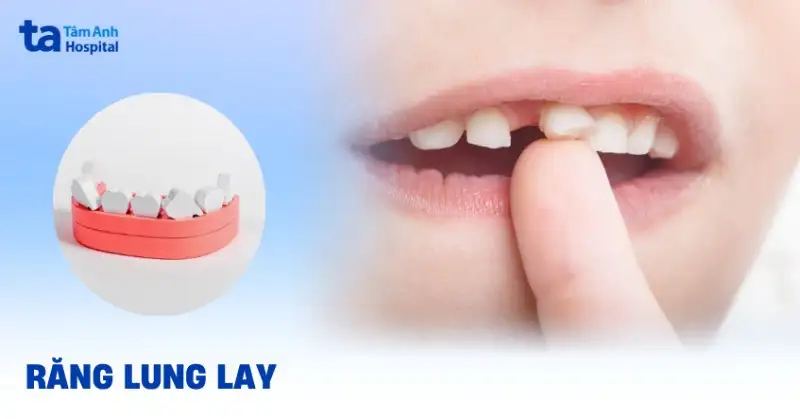 nằm mơ thấy răng lung lay rồi rụng