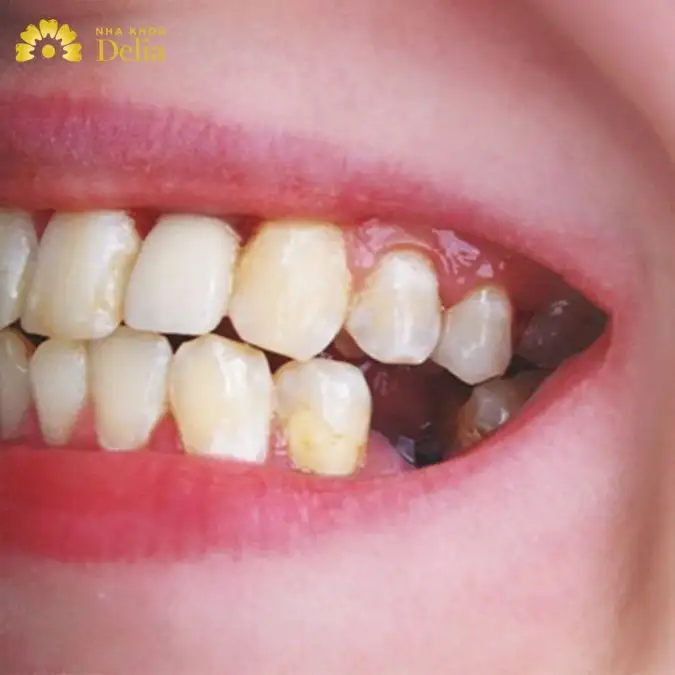 Nằm Mơ Thấy Răng Bị Rụng: Giải Mã Điềm Báo & Ý Nghĩa Sâu Sắc Từ Khoa Học Đến Tâm Linh