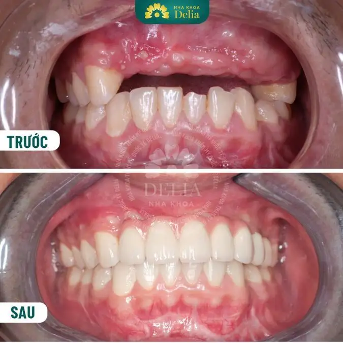 nằm mơ gãy răng hàm trên