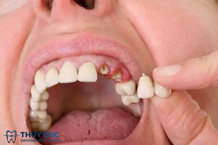 nằm mơ thấy rụng rang