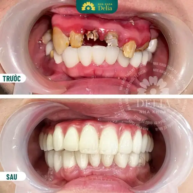 nằm mơ thấy mẻ răng không chảy máu