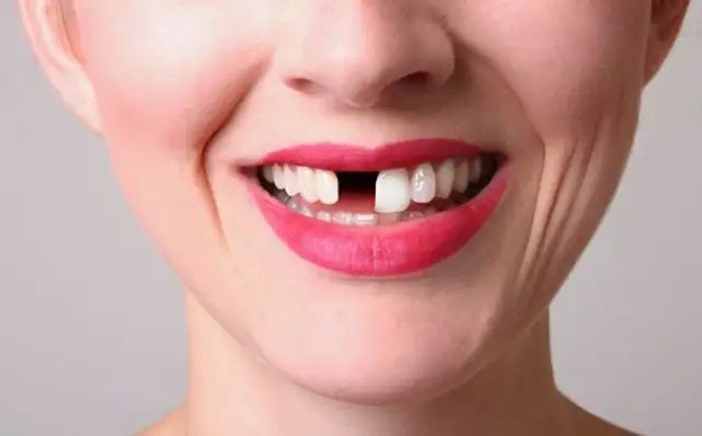 mơ thấy rụng hết răng không chảy máu